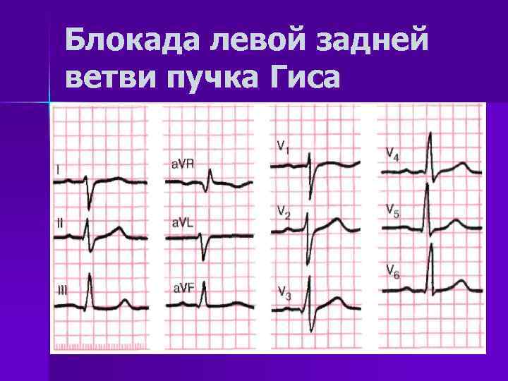 Блокада левой ветви ножки пучка. Неполная блокада задней ветви ЛНПГ ЭКГ. Блокада задней ветви пучка Гиса на ЭКГ. Блокада передней левой ножки пучка Гиса. Блокада задней ветви ЛНПГ на ЭКГ.