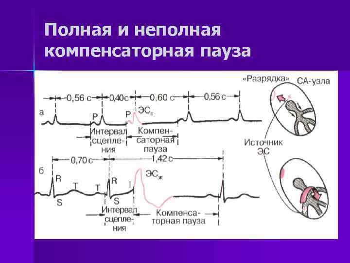 Полная и неполная компенсаторная пауза 