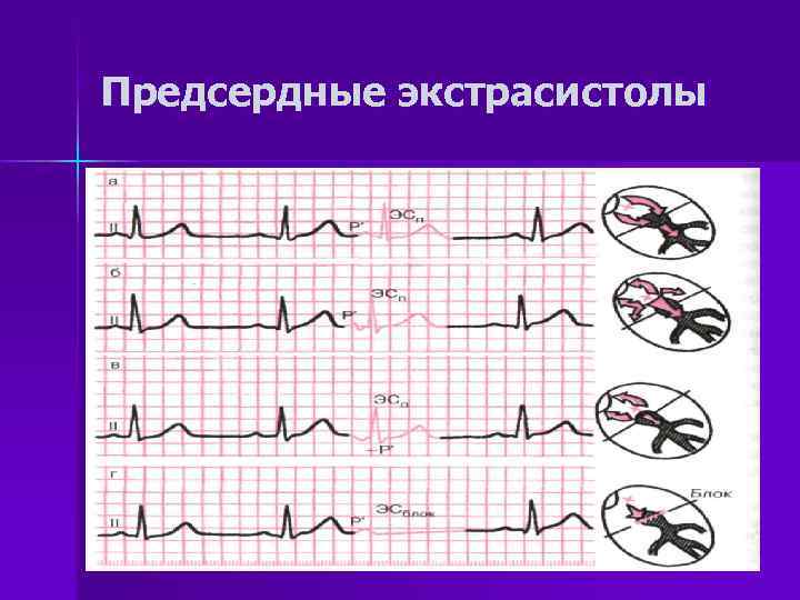 Предсердные экстрасистолы 