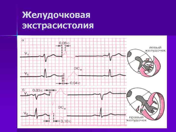 Желудочковая экстрасистолия 