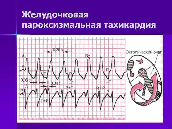 Желудочковая пароксизмальная тахикардия 