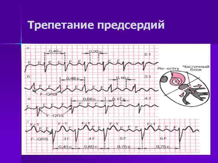 Трепетание предсердий 