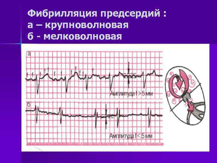 Фибрилляция предсердий на экг