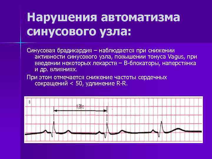 Синусовая брадикардия горизонтальная. ЭКГ при нарушении АВТОМАТИЗМА сердца. Синусовая брадиаритмия на ЭКГ.