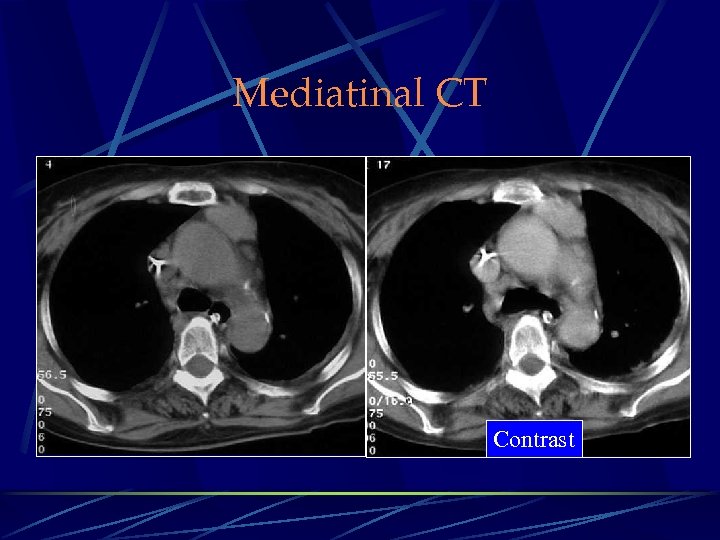 Mediatinal CT Contrast 