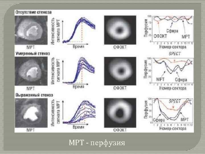 МРТ - перфузия 