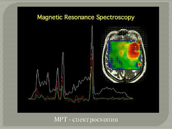 МРТ - спектроскопия 
