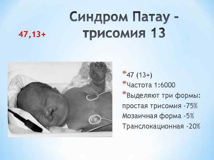 47, 13+ *47 (13+) *Частота 1: 6000 *Выделяют три формы: простая трисомия -75% Мозаичная