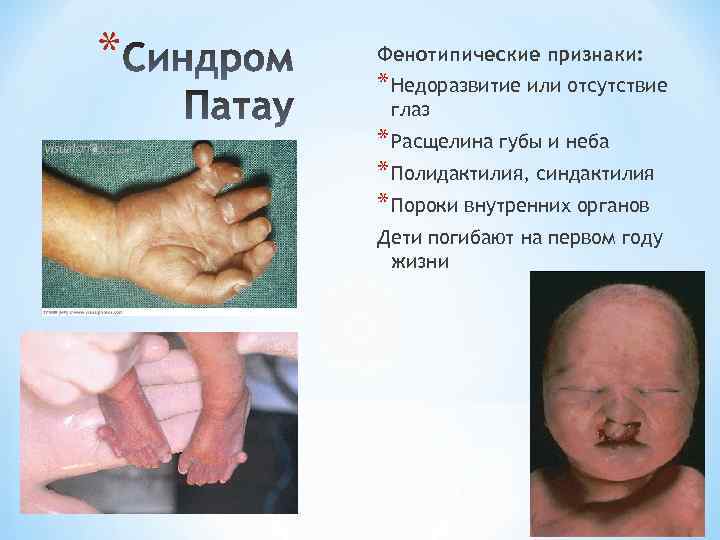 * Фенотипические признаки: * Недоразвитие или отсутствие глаз * Расщелина губы и неба *