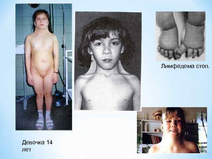 Лимфедема стоп. Девочка 14 лет 