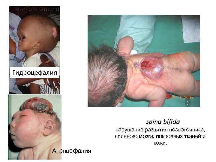 Гидроцефалия spina bifida нарушение развития позвоночника, спинного мозга, покровных тканей и кожи. Анэнцефалия 