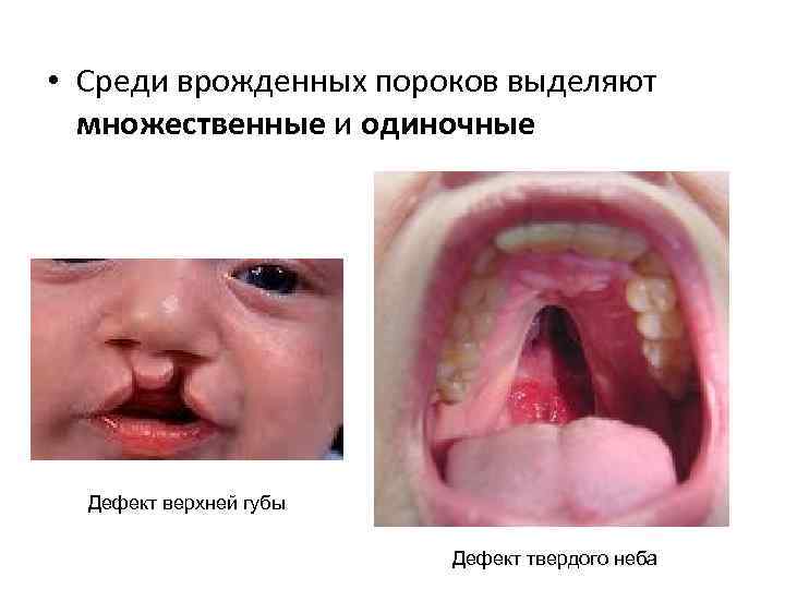  • Среди врожденных пороков выделяют множественные и одиночные Дефект верхней губы Дефект твердого