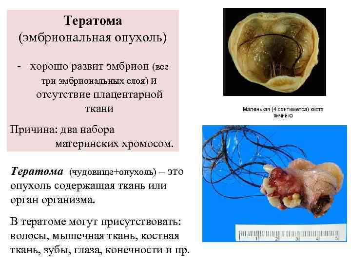 Тератома (эмбриональная опухоль) - хорошо развит эмбрион (все три эмбриональных слоя) и отсутствие плацентарной