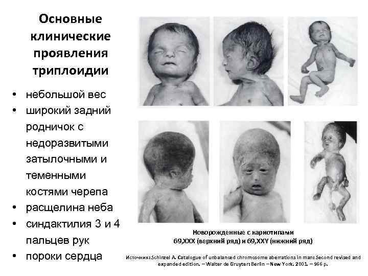 Основные клинические проявления триплоидии • небольшой вес • широкий задний родничок с недоразвитыми затылочными