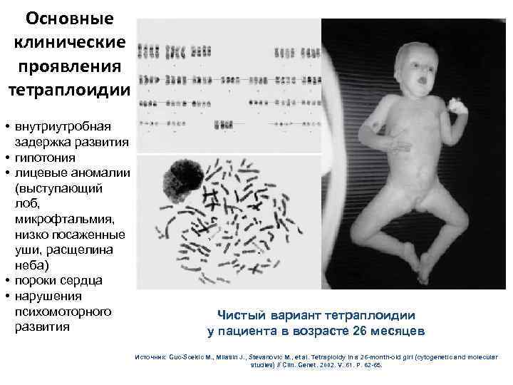Основные клинические проявления тетраплоидии • внутриутробная задержка развития • гипотония • лицевые аномалии (выступающий