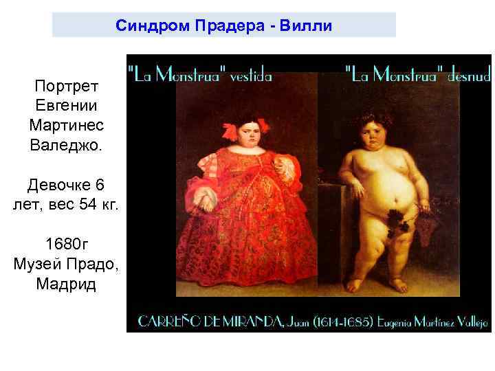 Синдром Прадера - Вилли Портрет Евгении Мартинес Валеджо. Девочке 6 лет, вес 54 кг.