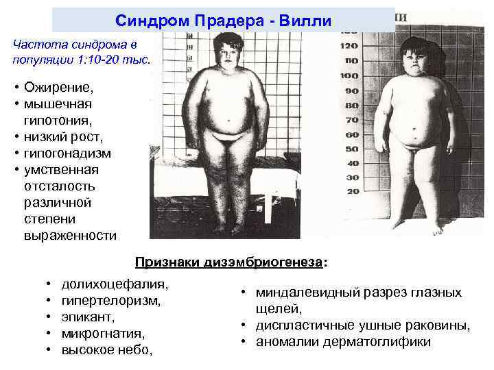 Синдром Прадера - Вилли Частота синдрома в популяции 1: 10 -20 тыс. • Ожирение,