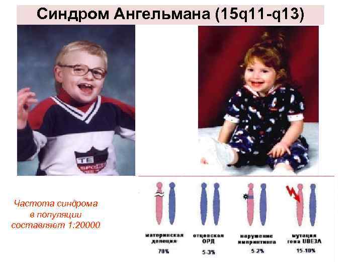 Синдром Ангельмана (15 q 11 -q 13) Частота синдрома в популяции составляет 1: 20000