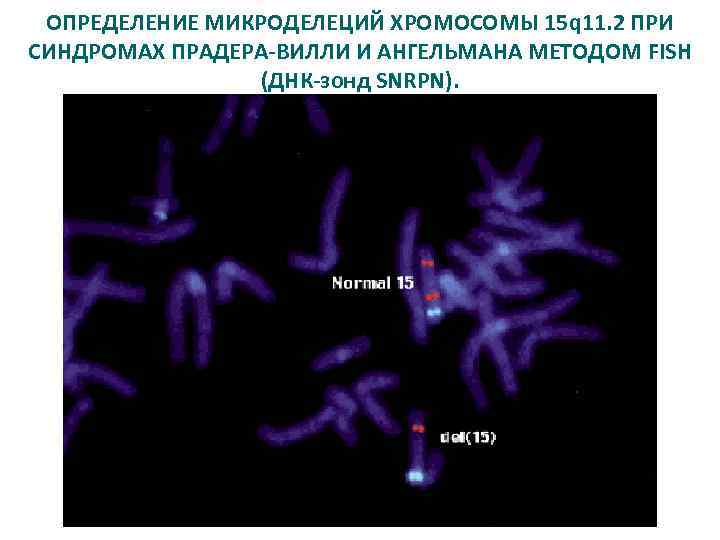 ОПРЕДЕЛЕНИЕ МИКРОДЕЛЕЦИЙ ХРОМОСОМЫ 15 q 11. 2 ПРИ СИНДРОМАХ ПРАДЕРА-ВИЛЛИ И АНГЕЛЬМАНА МЕТОДОМ FISH