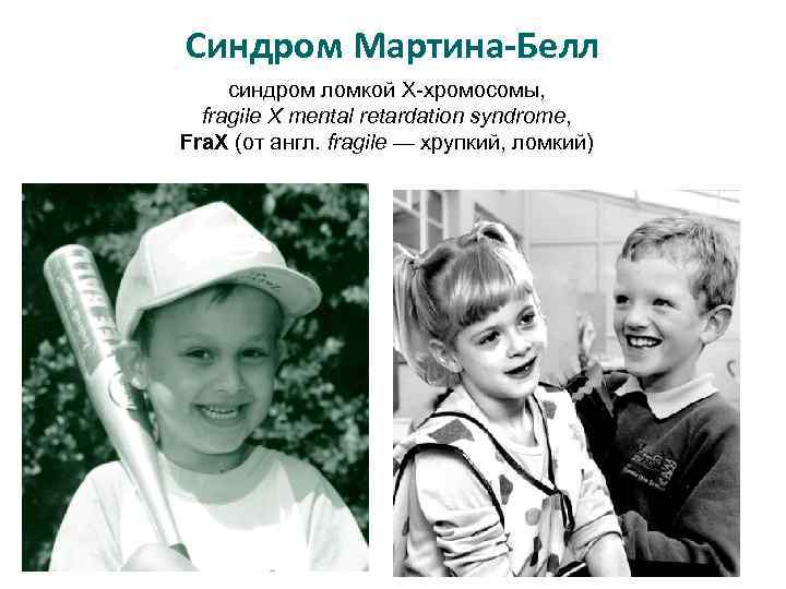 Синдром Мартина-Белл синдром ломкой X-хромосомы, fragile X mental retardation syndrome, Fra. X (от англ.
