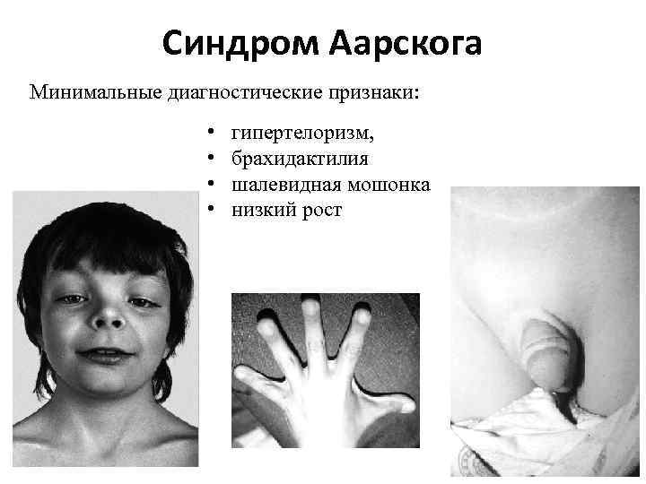 Синдром Аарскога Минимальные диагностические признаки: • • гипертелоризм, брахидактилия шалевидная мошонка низкий рост 