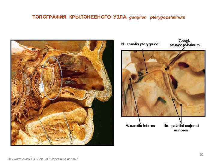 ТОПОГРАФИЯ КРЫЛОНЕБНОГО УЗЛА, ganglion pterygopalatinum N. canalis pterygoidei A. carotis interna Gangl. pterygopalatinum Nn.