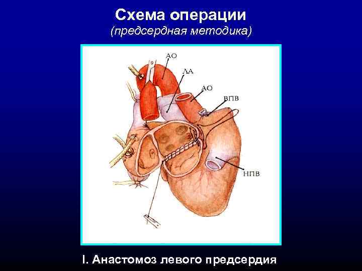Схема операции (предсердная методика) I. Анастомоз левого предсердия 