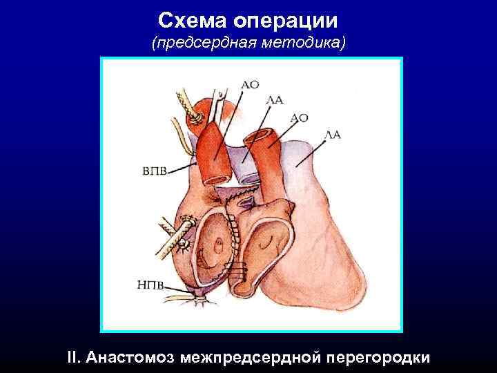 Схема операции (предсердная методика) II. Анастомоз межпредсердной перегородки 