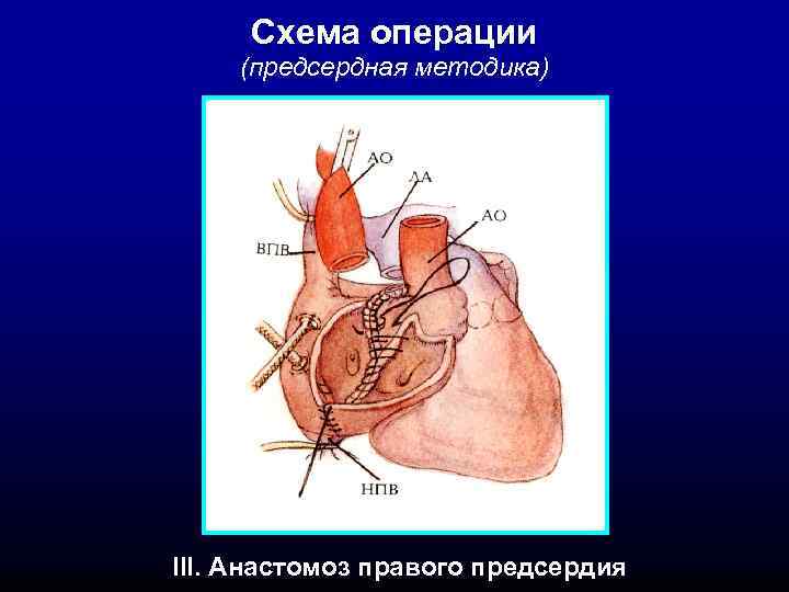 Схема операции (предсердная методика) III. Анастомоз правого предсердия 
