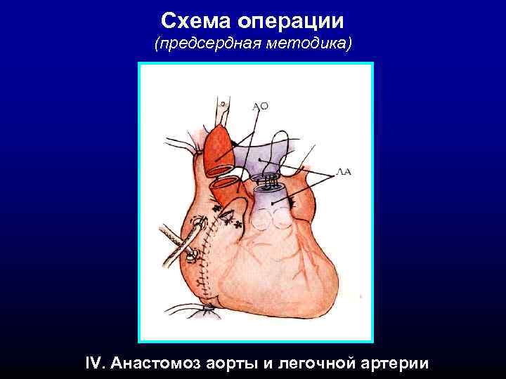 Схема операции (предсердная методика) IV. Анастомоз аорты и легочной артерии 