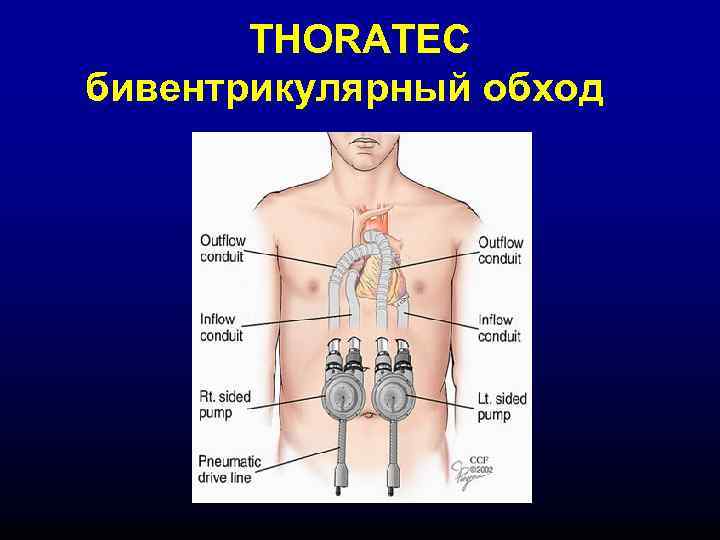THORATEC бивентрикулярный обход 