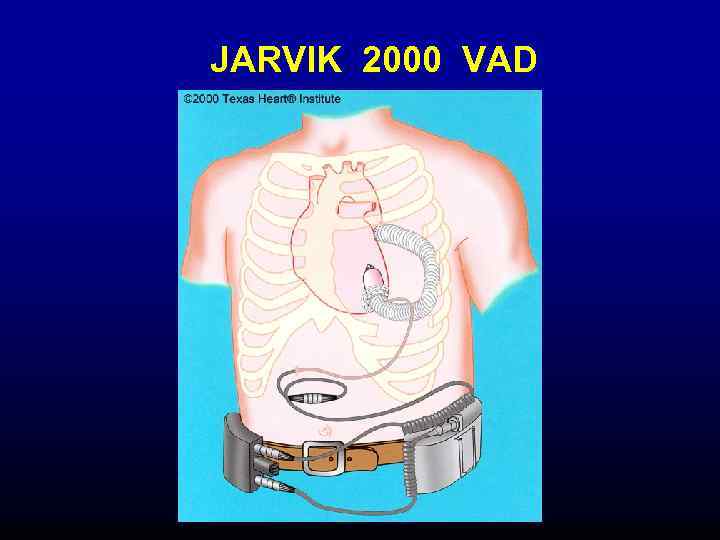 JARVIK 2000 VAD 
