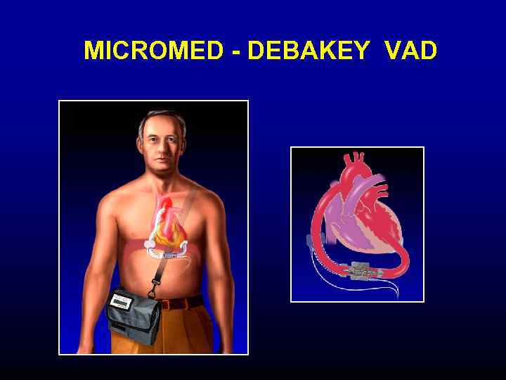 MICROMED - DEBAKEY VAD 