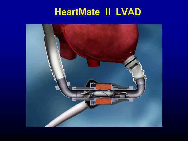 Heart. Mate II LVAD 