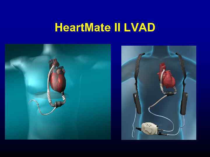 Heart. Mate II LVAD 