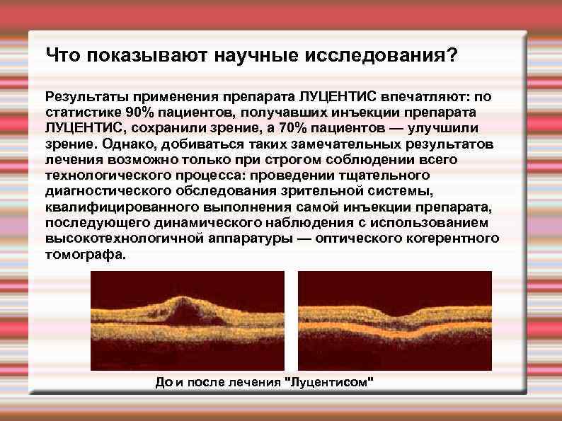 Что показывают научные исследования? Результаты применения препарата ЛУЦЕНТИС впечатляют: по статистике 90% пациентов, получавших