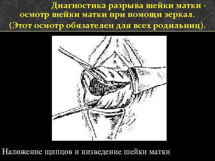 Диагностика разрыва шейки матки осмотр шейки матки при помощи зеркал. (Этот осмотр обязателен для