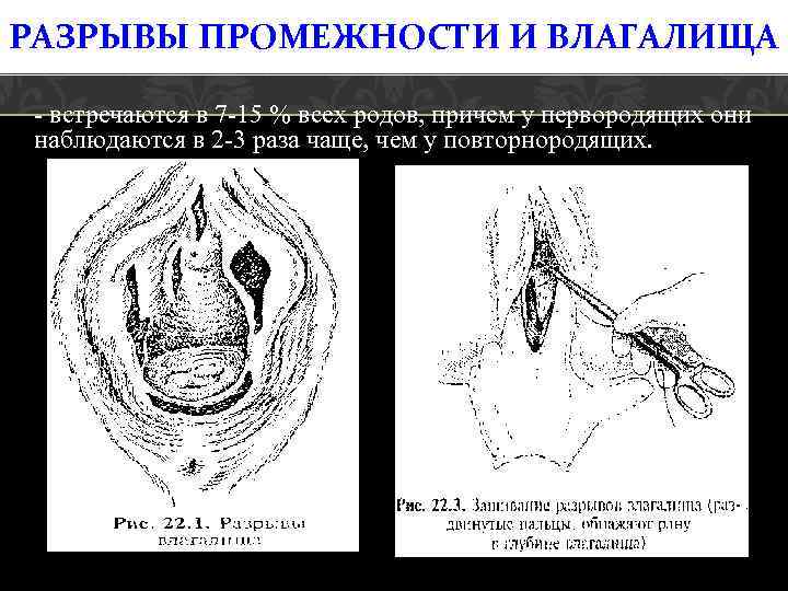 РАЗРЫВЫ ПРОМЕЖНОСТИ И ВЛАГАЛИЩА - встречаются в 7 -15 % всех родов, причем у