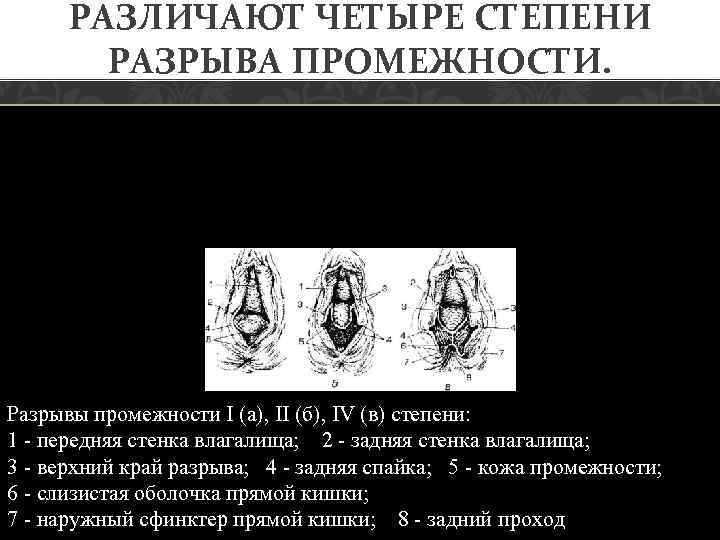 РАЗЛИЧАЮТ ЧЕТЫРЕ СТЕПЕНИ РАЗРЫВА ПРОМЕЖНОСТИ. Разрывы промежности I (а), II (б), IV (в) степени: