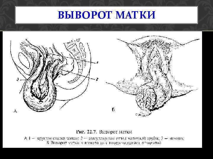 ВЫВОРОТ МАТКИ 