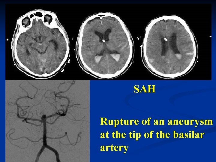 SAH Rupture of an aneurysm at the tip of the basilar artery 