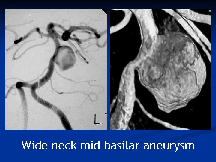 Wide neck mid basilar aneurysm 