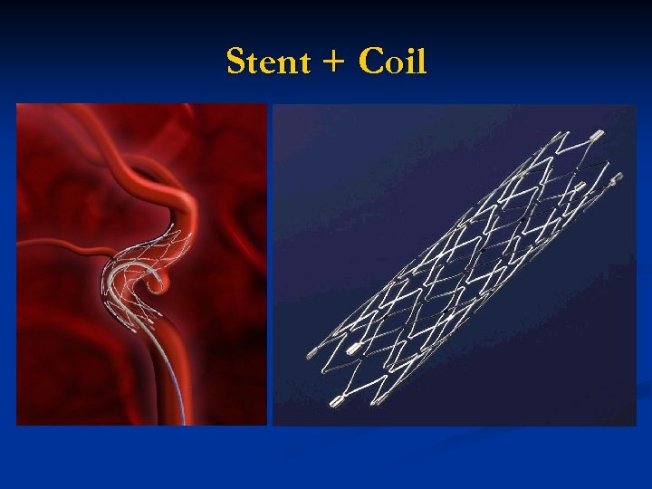 Stent + Coil 