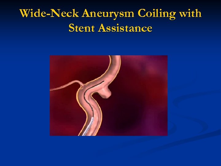 Wide-Neck Aneurysm Coiling with Stent Assistance 