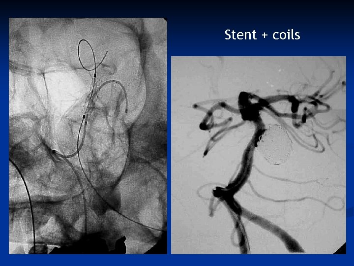 Stent + coils 
