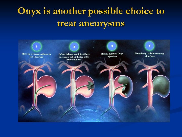 Onyx is another possible choice to treat aneurysms 