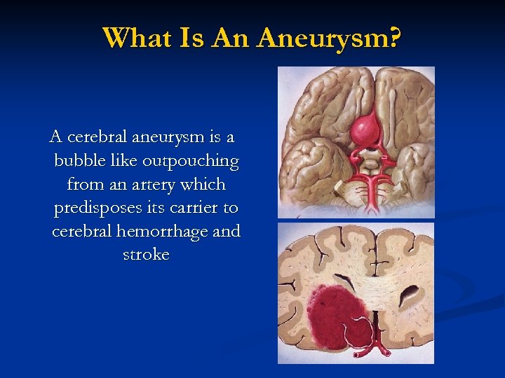 What Is An Aneurysm? A cerebral aneurysm is a bubble like outpouching from an