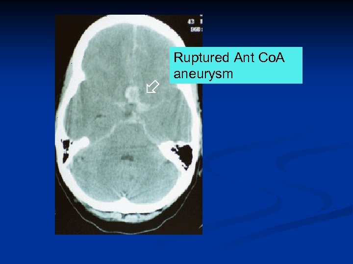  Ruptured Ant Co. A aneurysm 