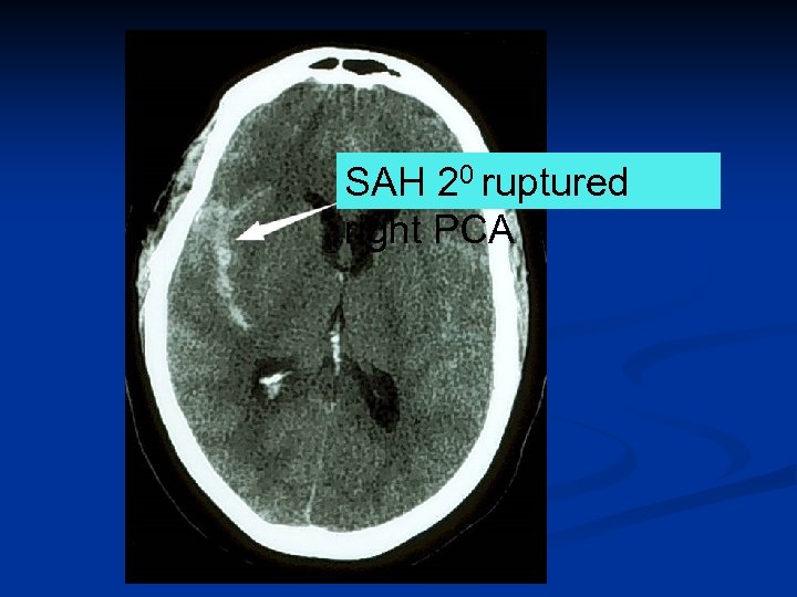 SAH 20 ruptured right PCA 