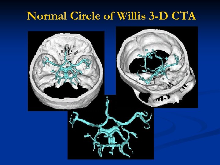 Normal Circle of Willis 3 -D CTA 